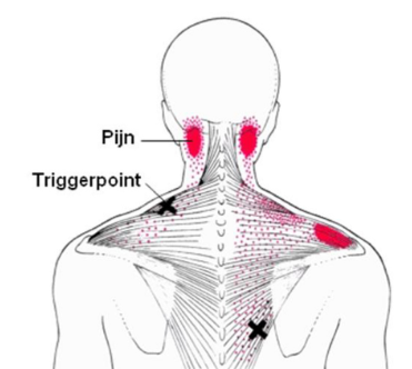 afbeelding van: https://npva.nl/content/acupunctuur-en-dry-needling